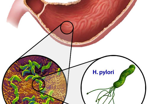 helicobacter_pylori-1